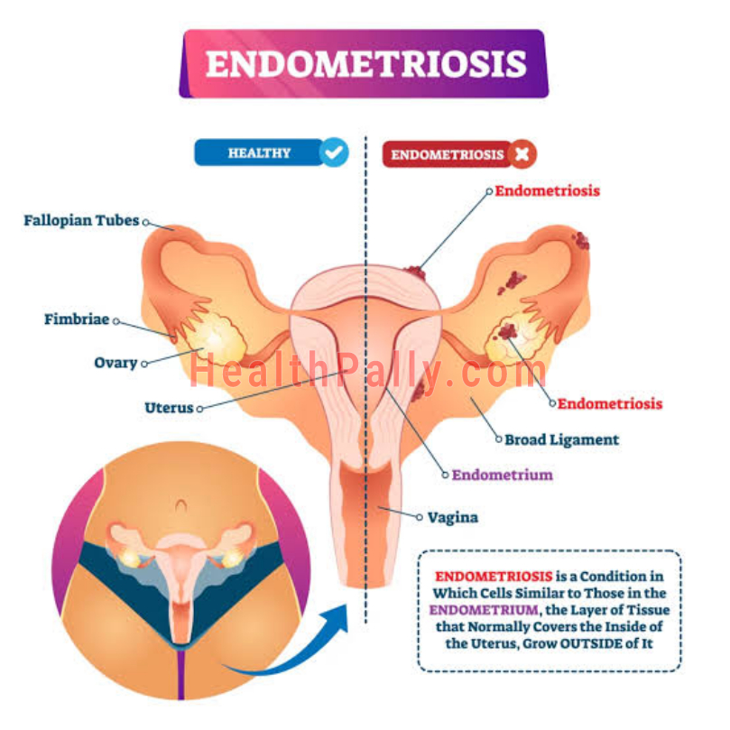 What is endometriosis and infertility