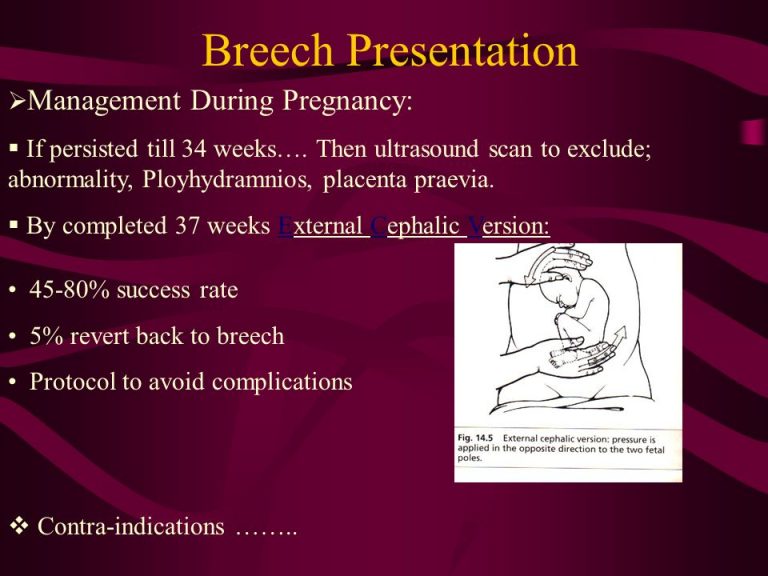 what is a breech presentation why is it a complication