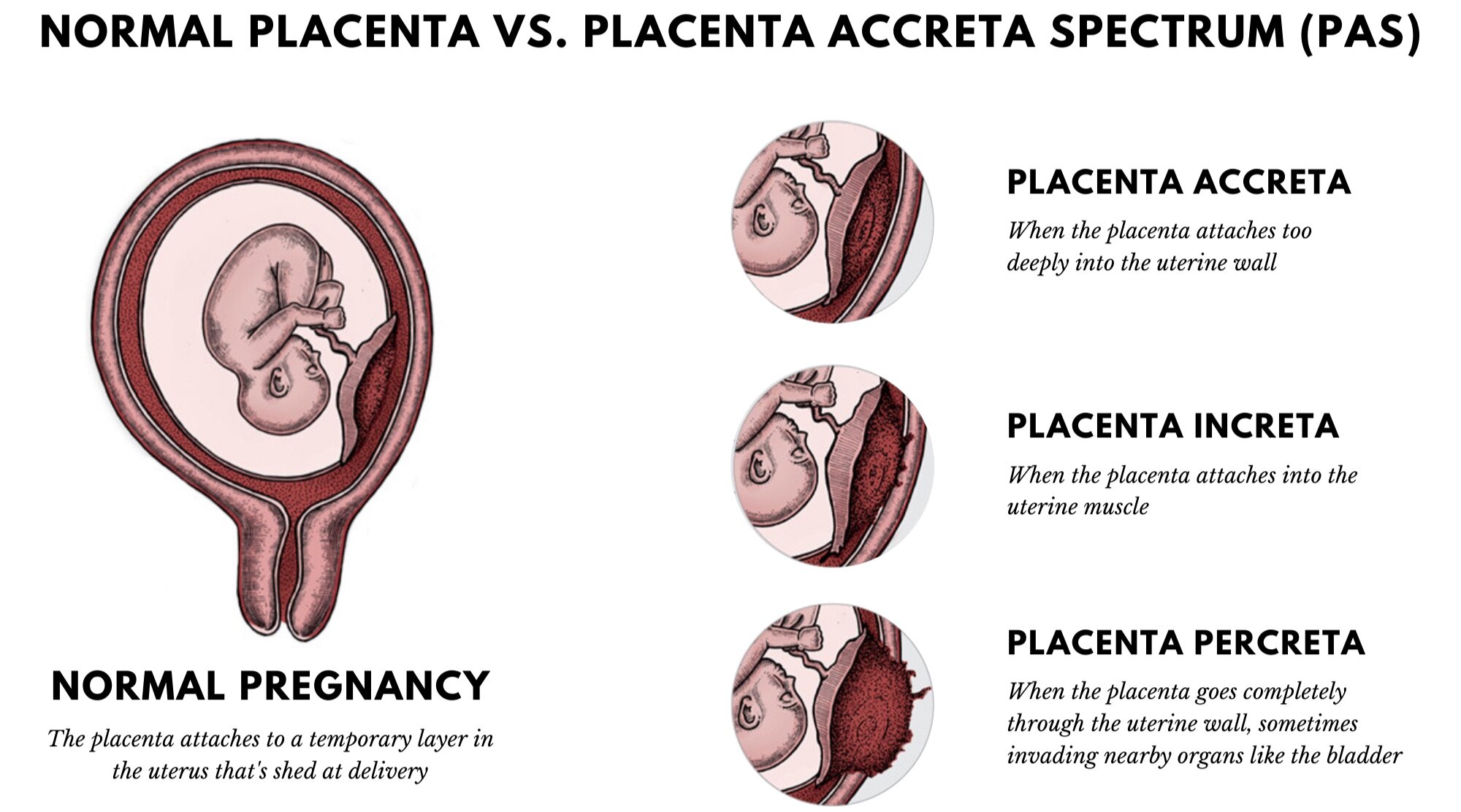 Placental Problems During Pregnancy And Management HealthPally